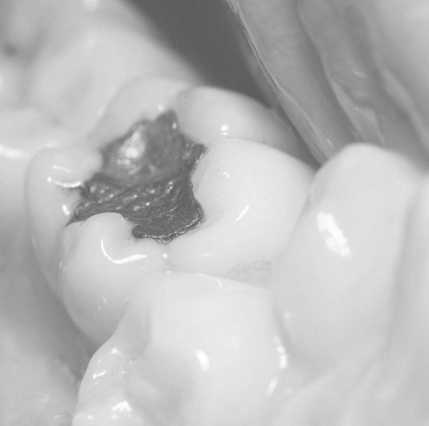 L'amalgame la vérité Centre Dentaire BoisdesFilion Dentistes